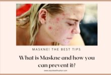 What is maskne and how you can prevent it?